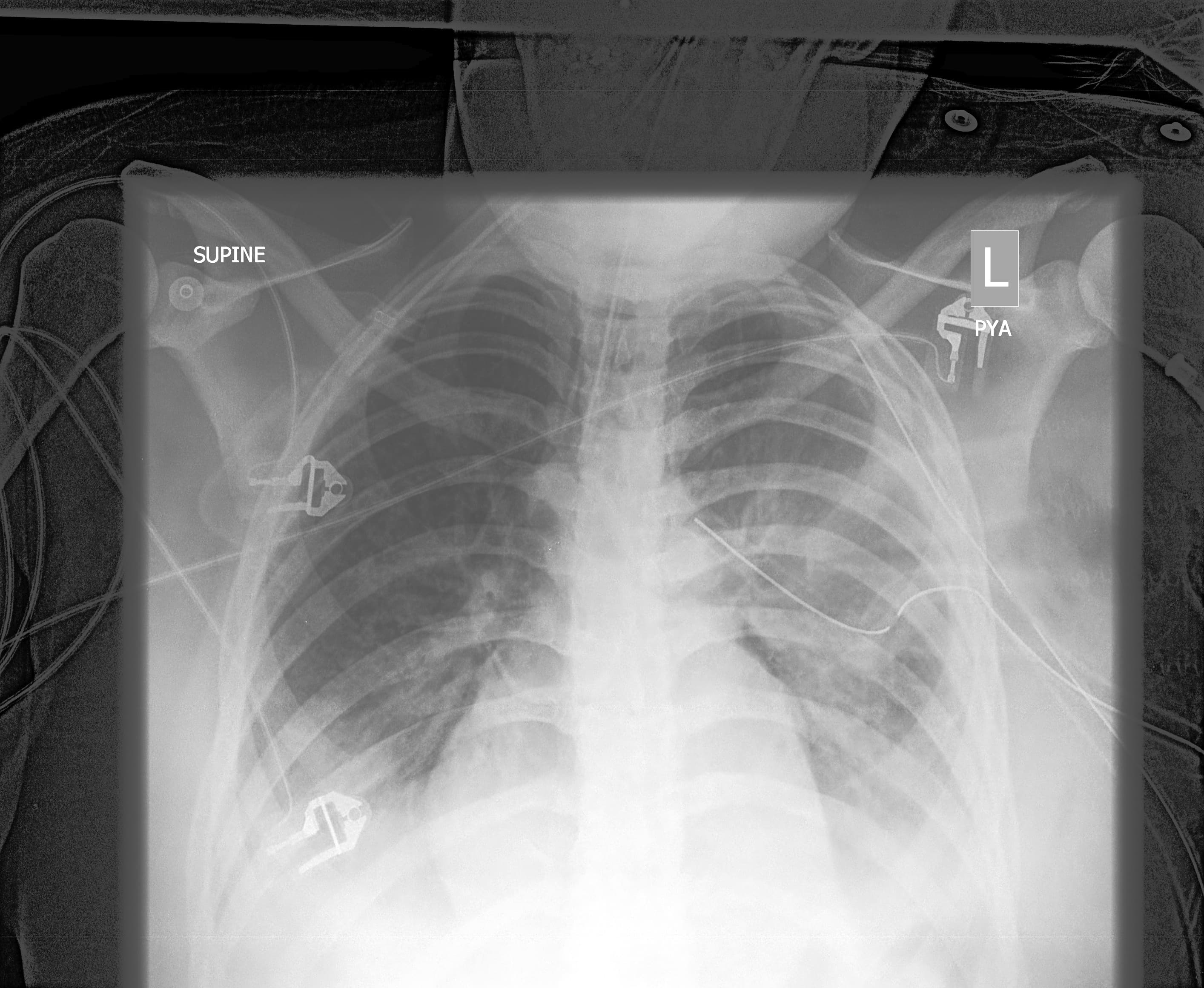 Chest X-ray Input